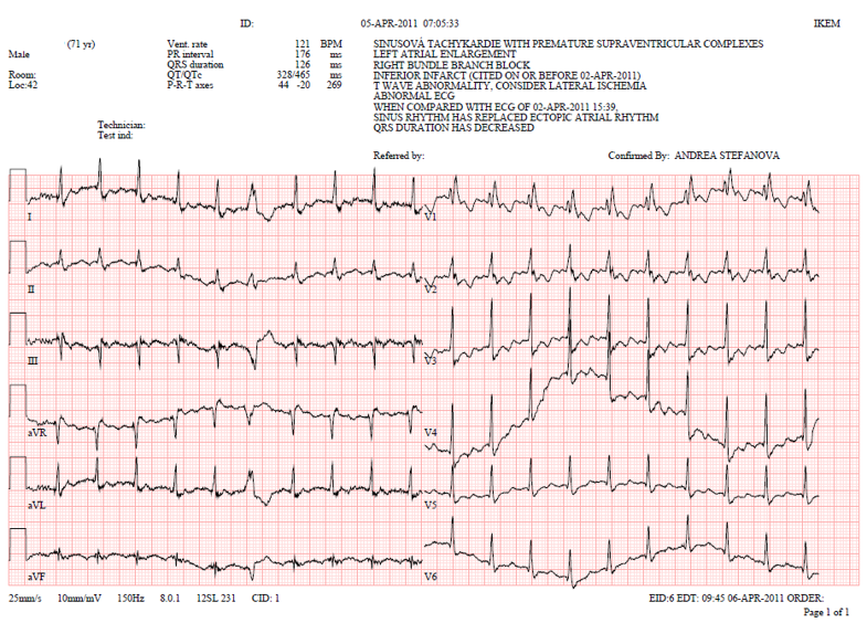EKG1